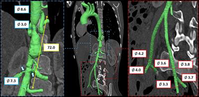 Case report: Personalized transcatheter approach to mid-aortic syndrome by in vitro simulation on a 3-dimensional printed model